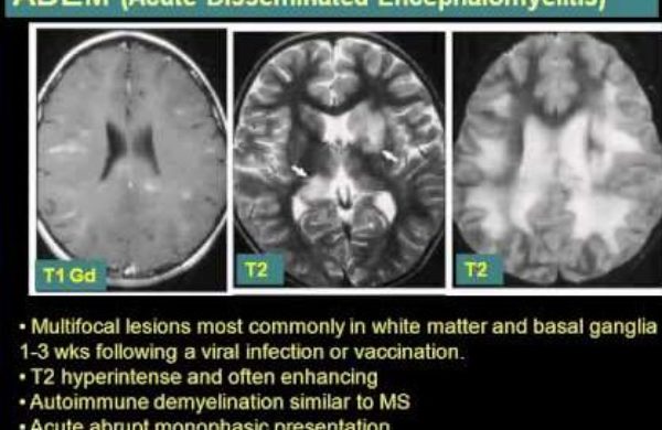 What Is White Matter Disease?